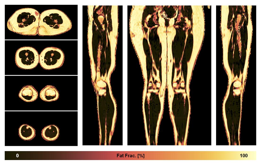 The fat fraction of the lower extremity obtained from the dixon reconstruction for muscle water fat quantification.